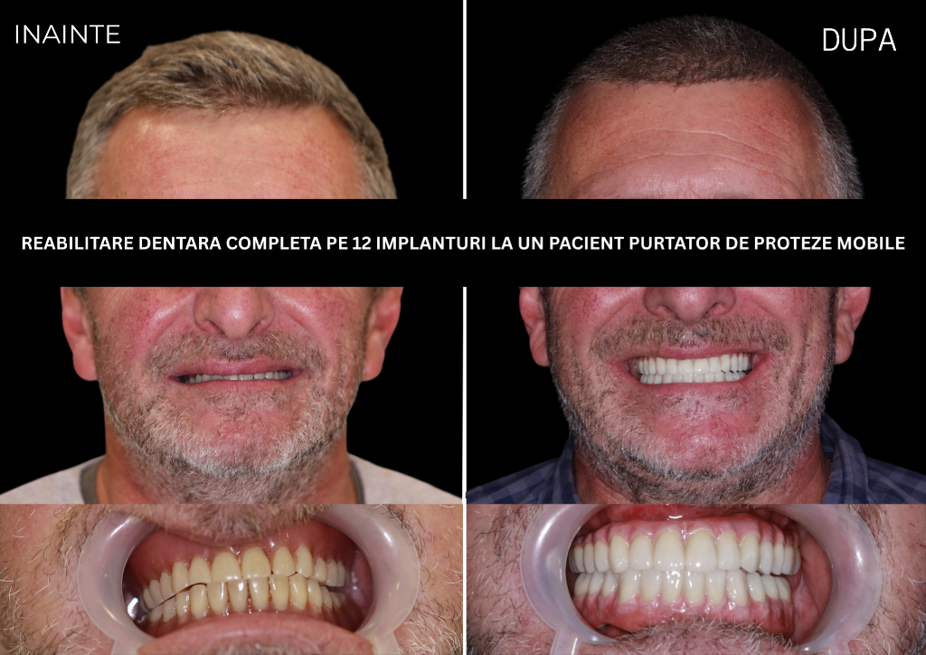 Rezultat tratament 9 — Reabilitare dentară completă pe 12 implanturi