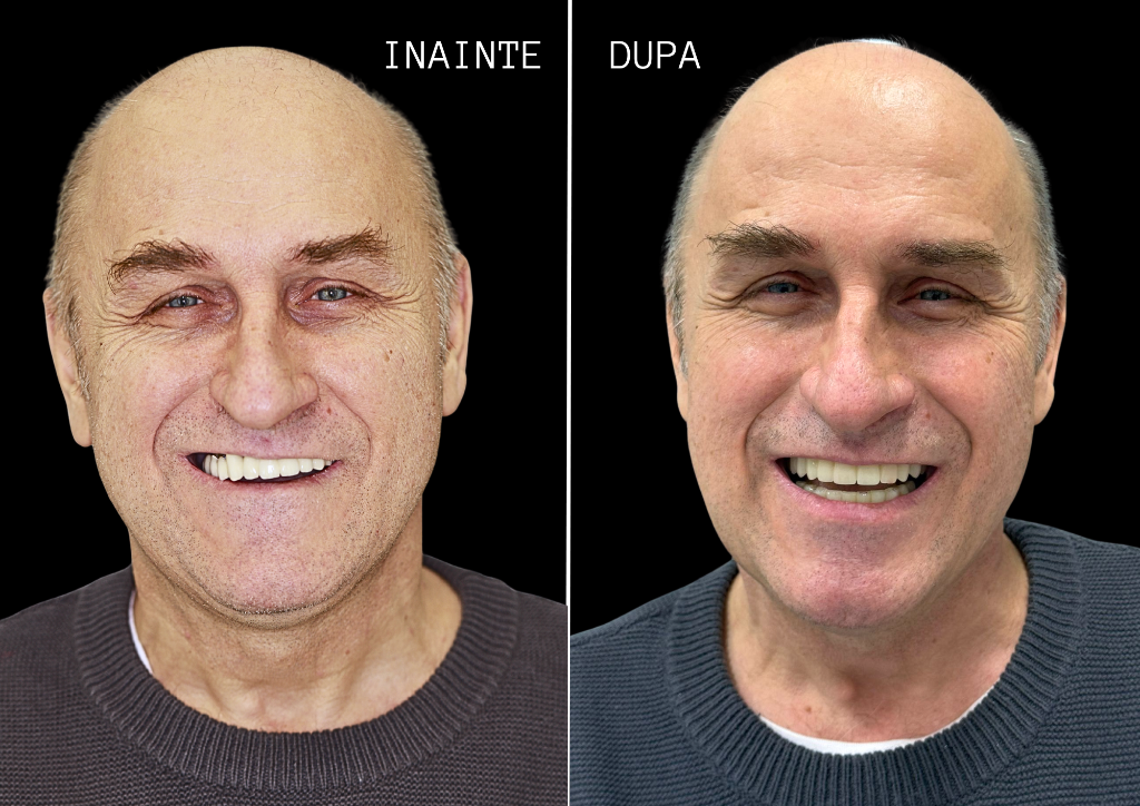 Rezultat tratament 4 — Reabilitare dentară bimaxilară pe 10 implanturi
