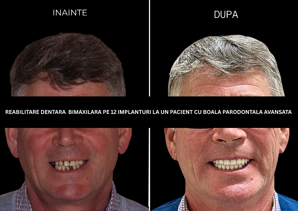 Rezultat tratament 10 — Reabilitare dentară bimaxilară pe 12 implanturi