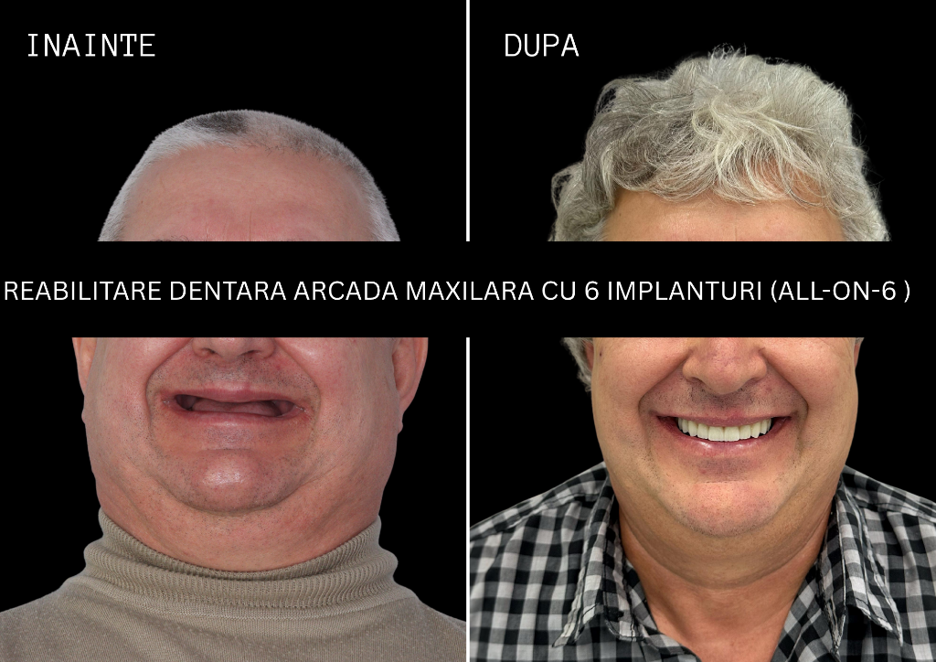 Rezultat tratament 8 — Reabilitare dentară arcadă maxilară cu 6 implanturi (All-on-6)
