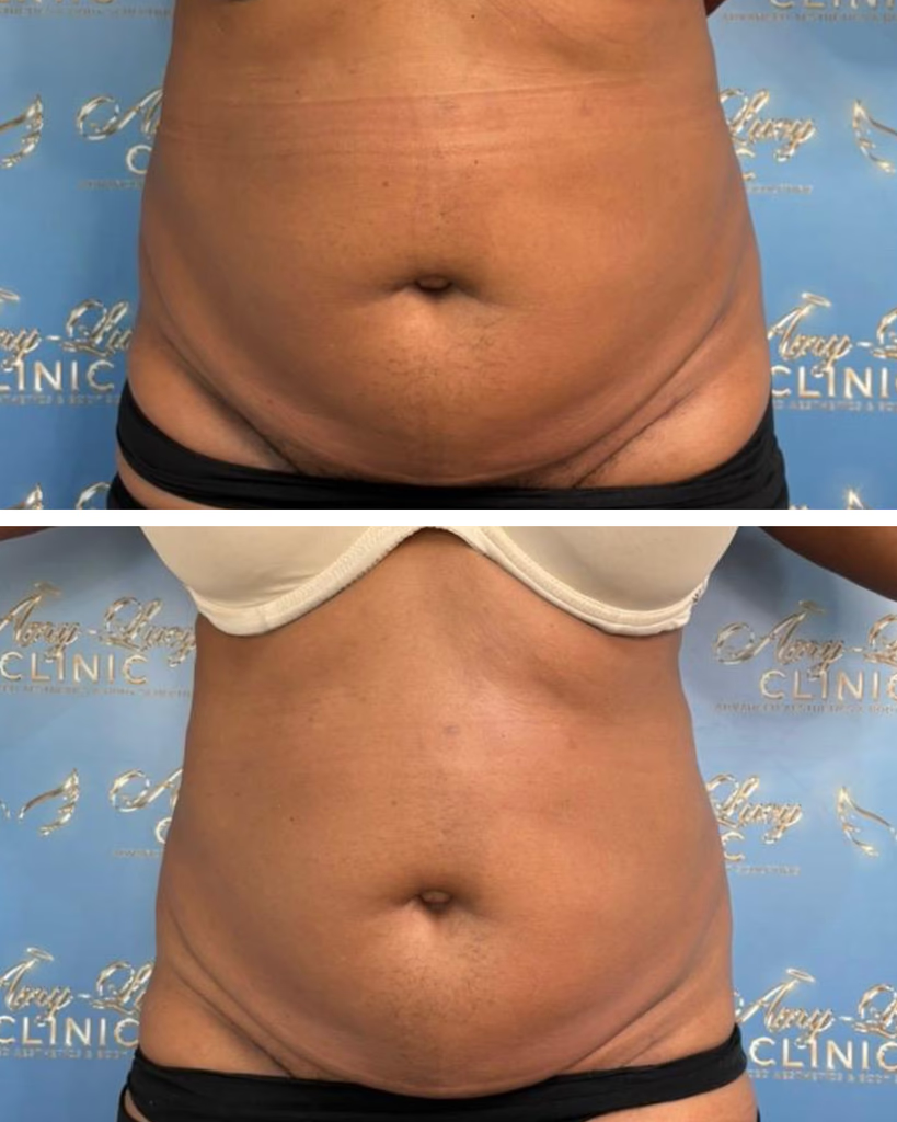 Before and after body sculpting, Fat Reduction
