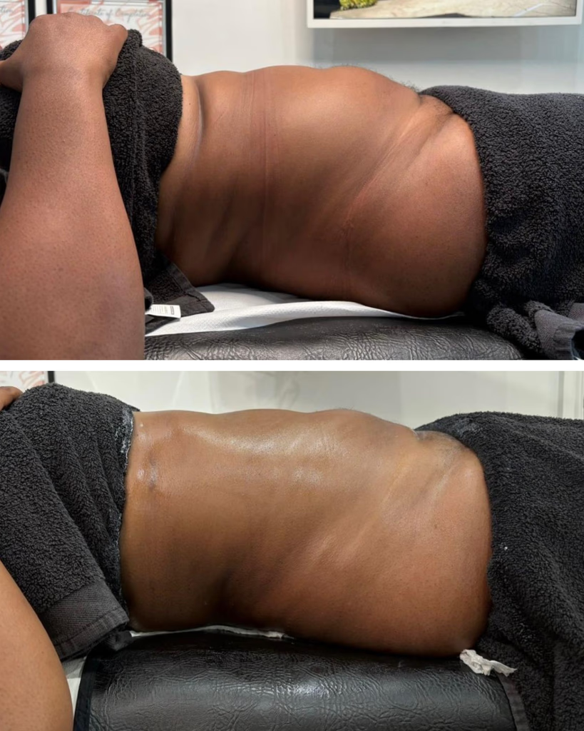 Before and after body sculpting, Contour & Definition