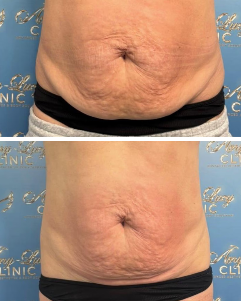 Before and after body sculpting, Skin Tightening