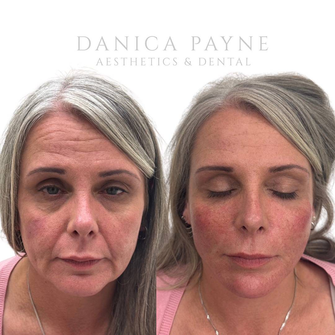 Danica Payne Full Face — Before & After