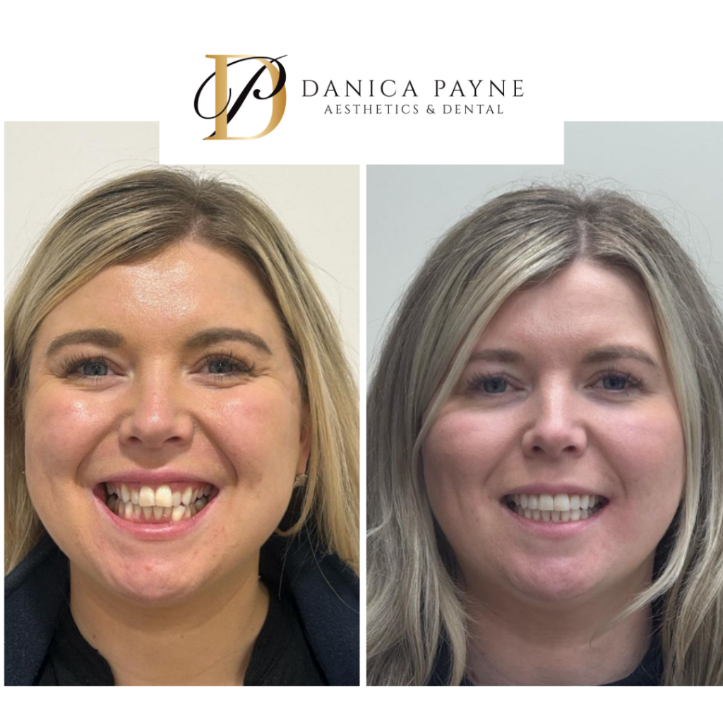 Invisalign Smile Transformation — Before & After