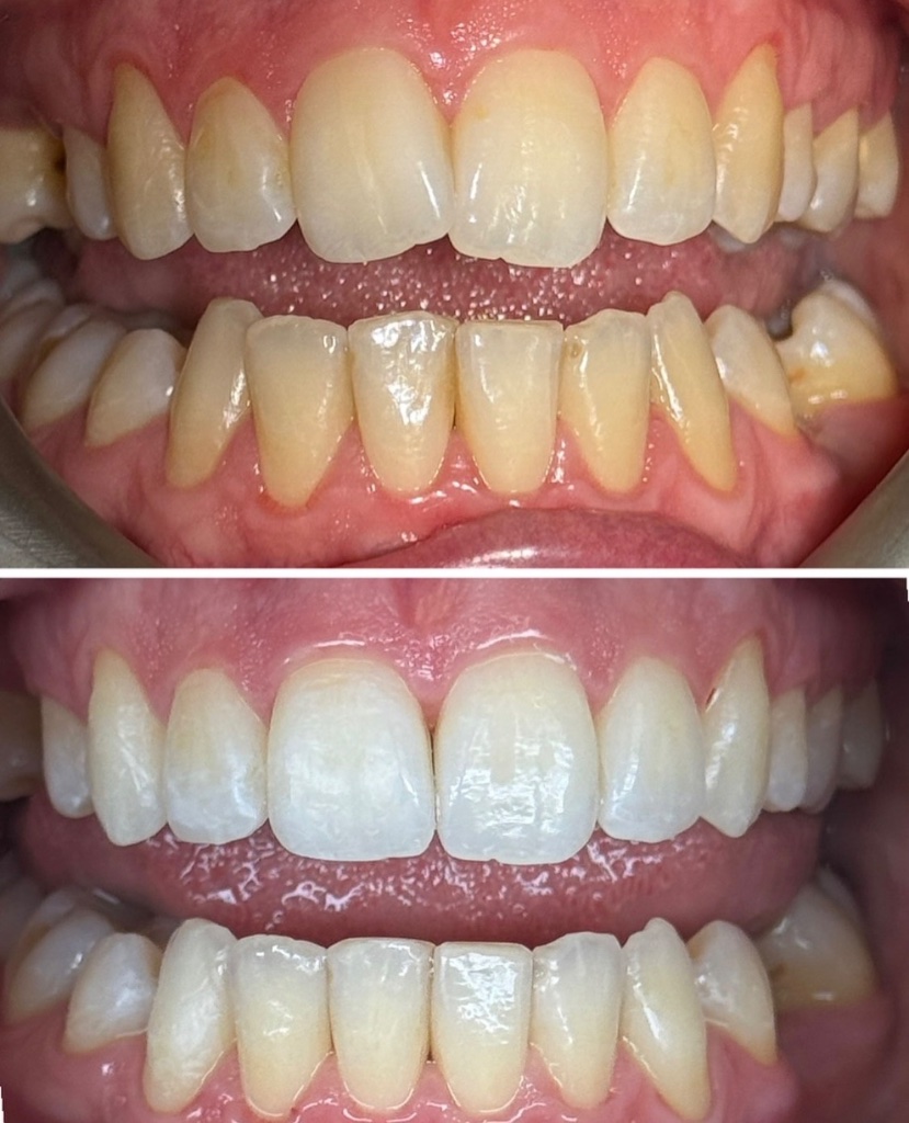 Invisalign before and after transformation 8