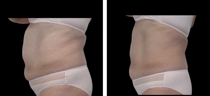 Stomach Fat Freezing (3 Sessions) — Before & After