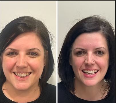 Dental Smile Makeover — Before & After