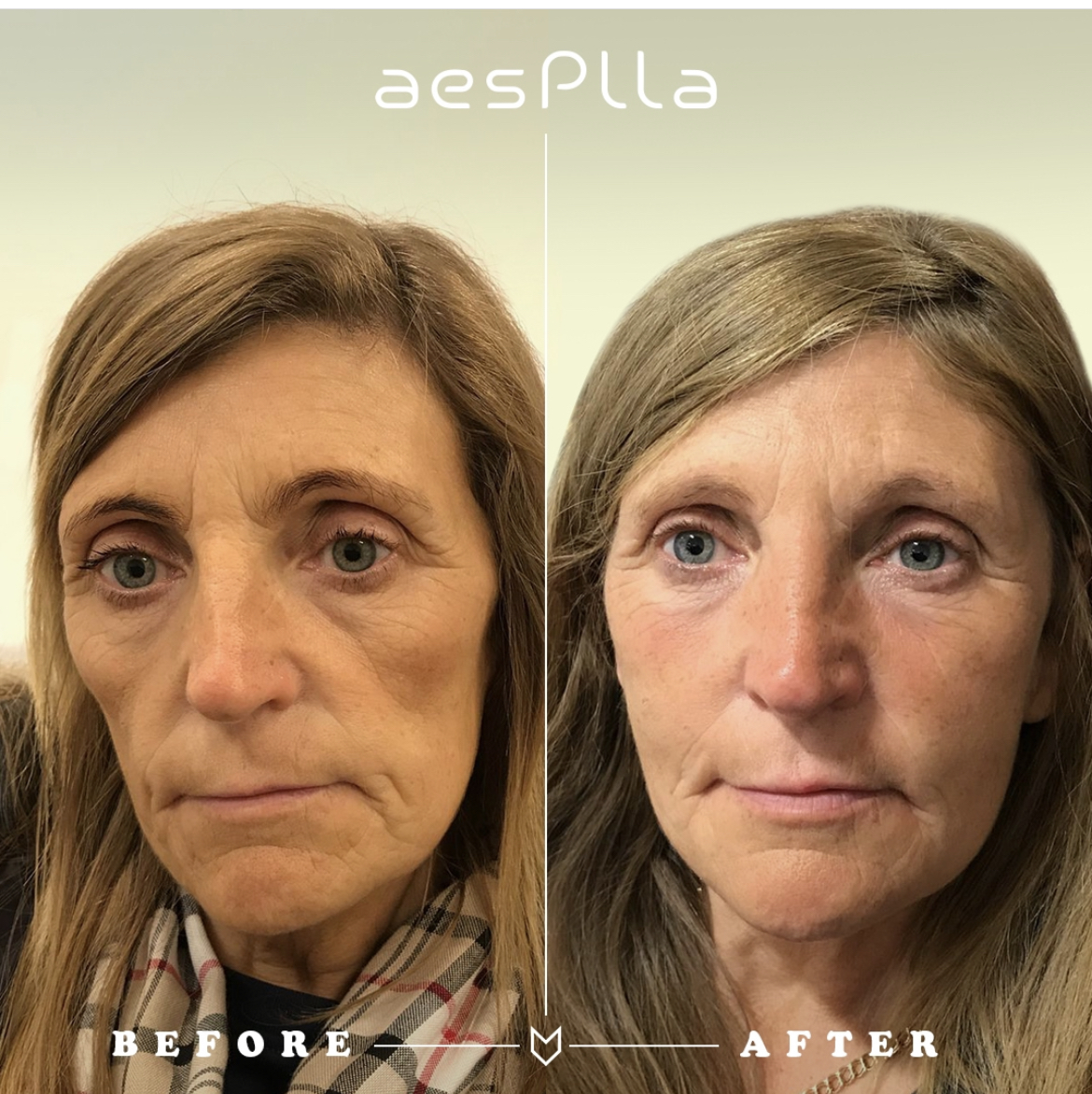 Aesthetic Rejuvenation — Before & After