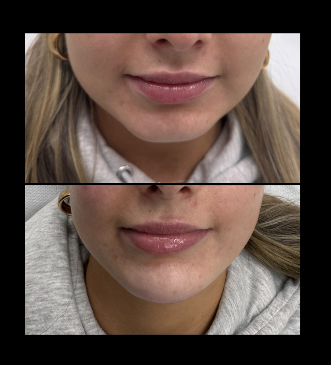 Chin Filler — Before & After