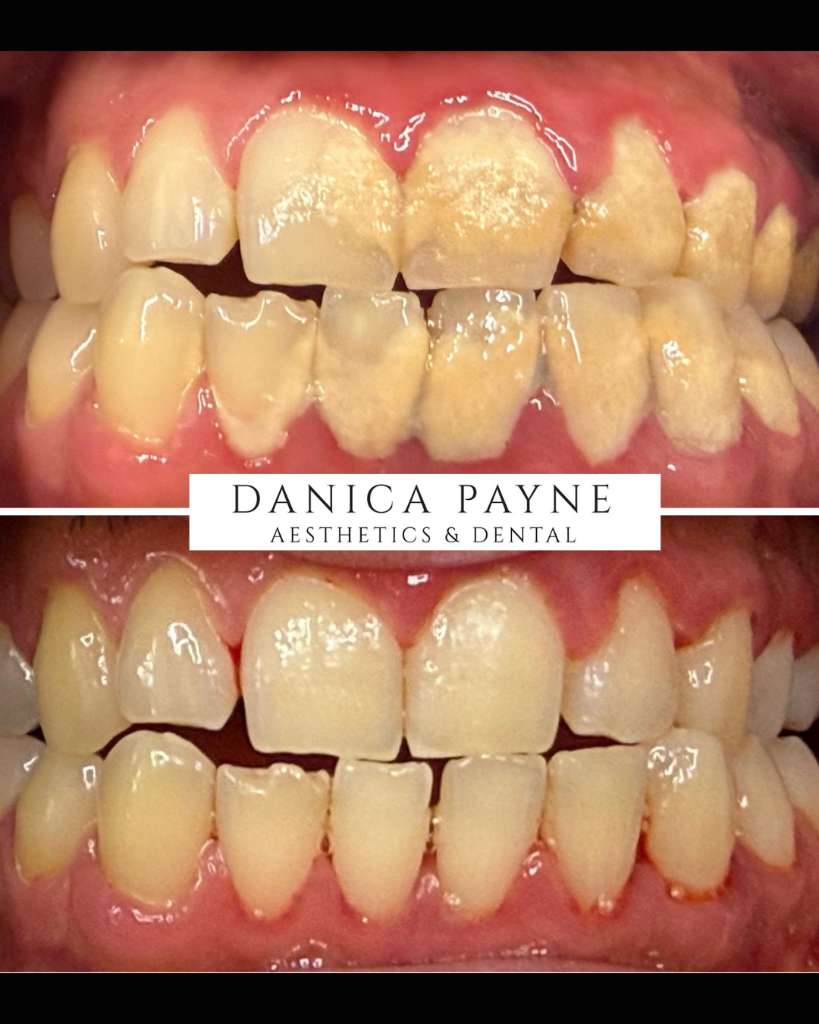 Airflow Dental Hygiene — Before & After