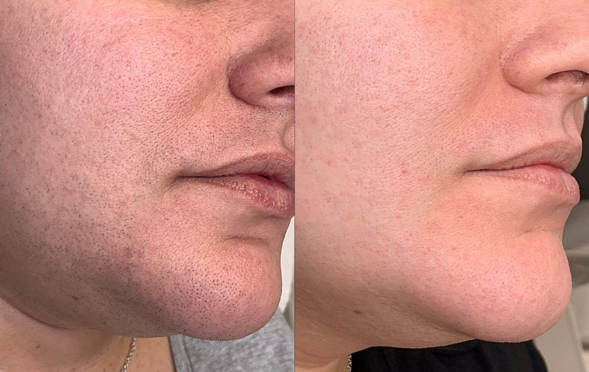 Laser Hair Removal — Before & After