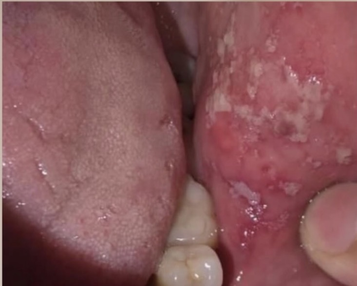 Intra-Oral Lesion — Emergency