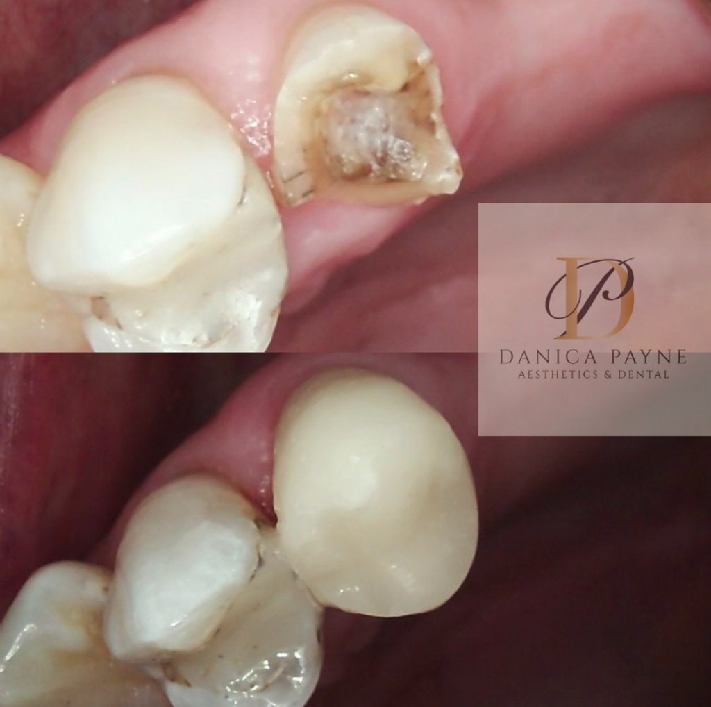 Dental Restoration — Before & After