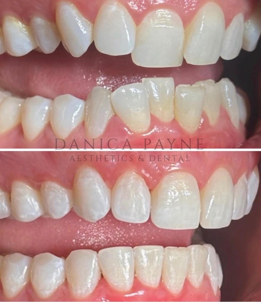 Invisalign before and after transformation 2
