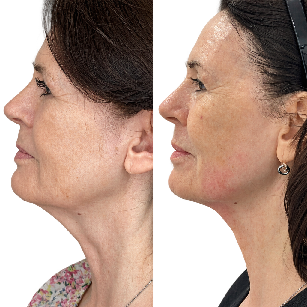HIFU Treatment — Before & After