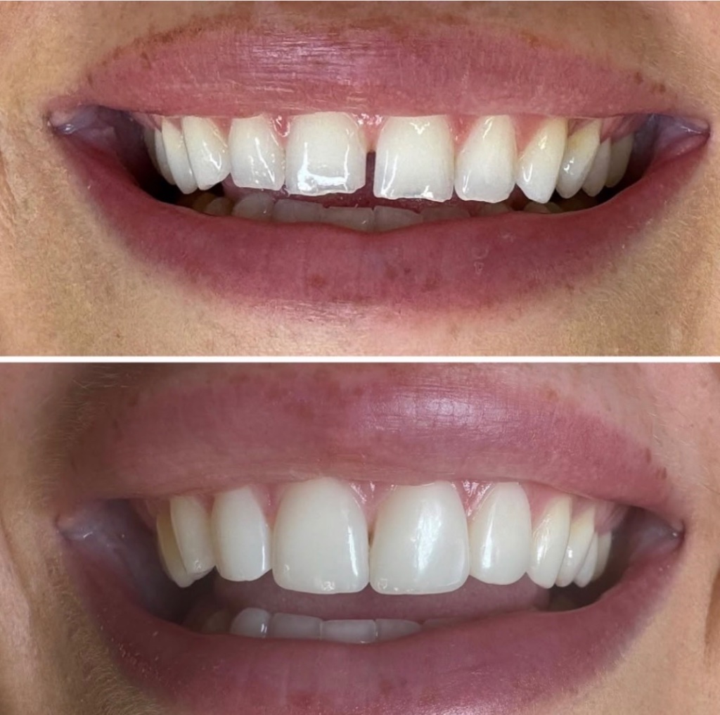 Composite bonding before and after — gap between front teeth closed