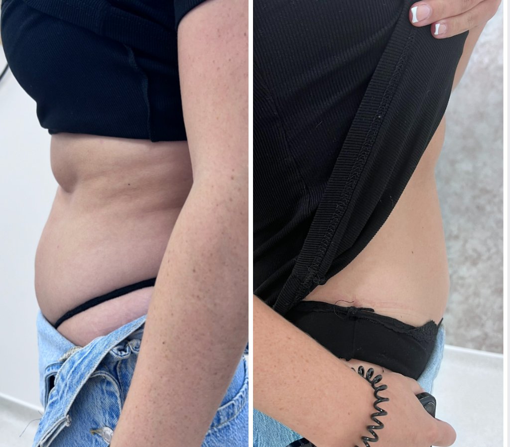 Body Contouring — Before & After