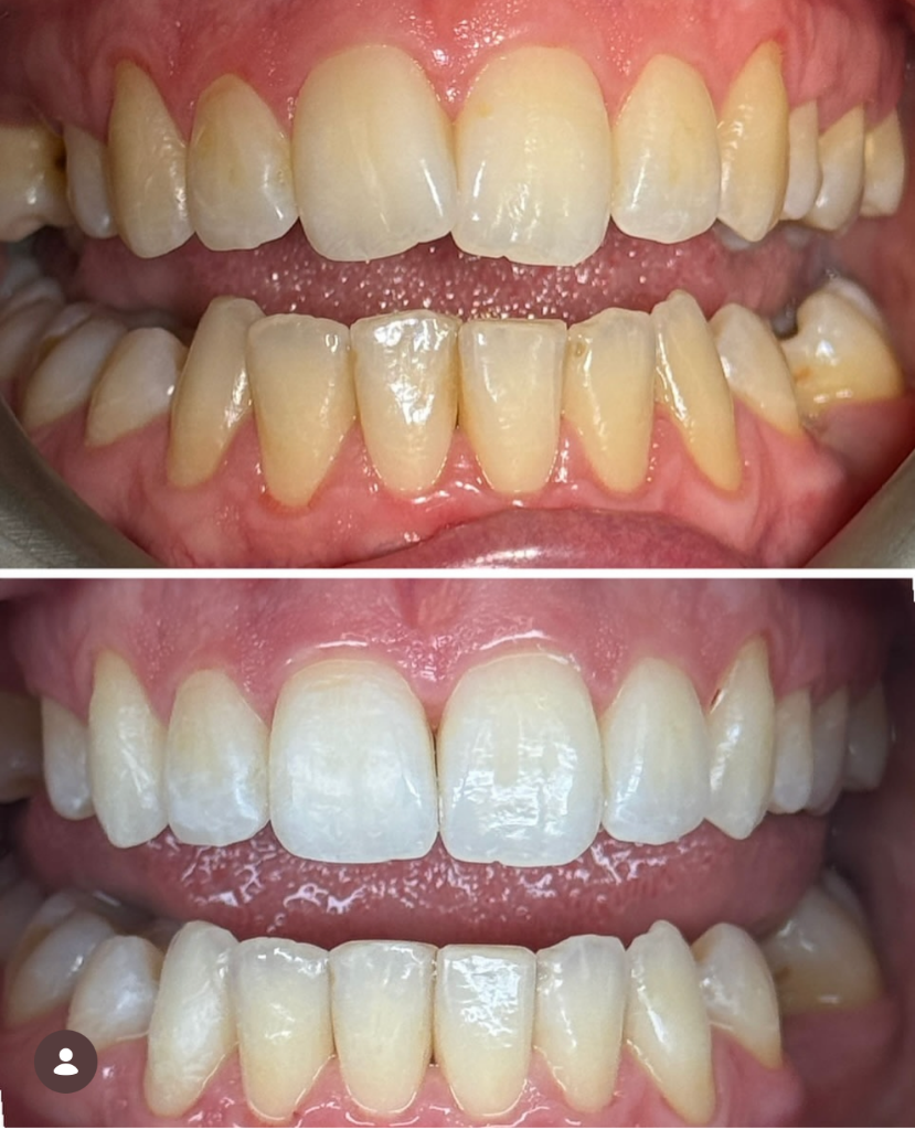 Teeth Whitening — Before & After