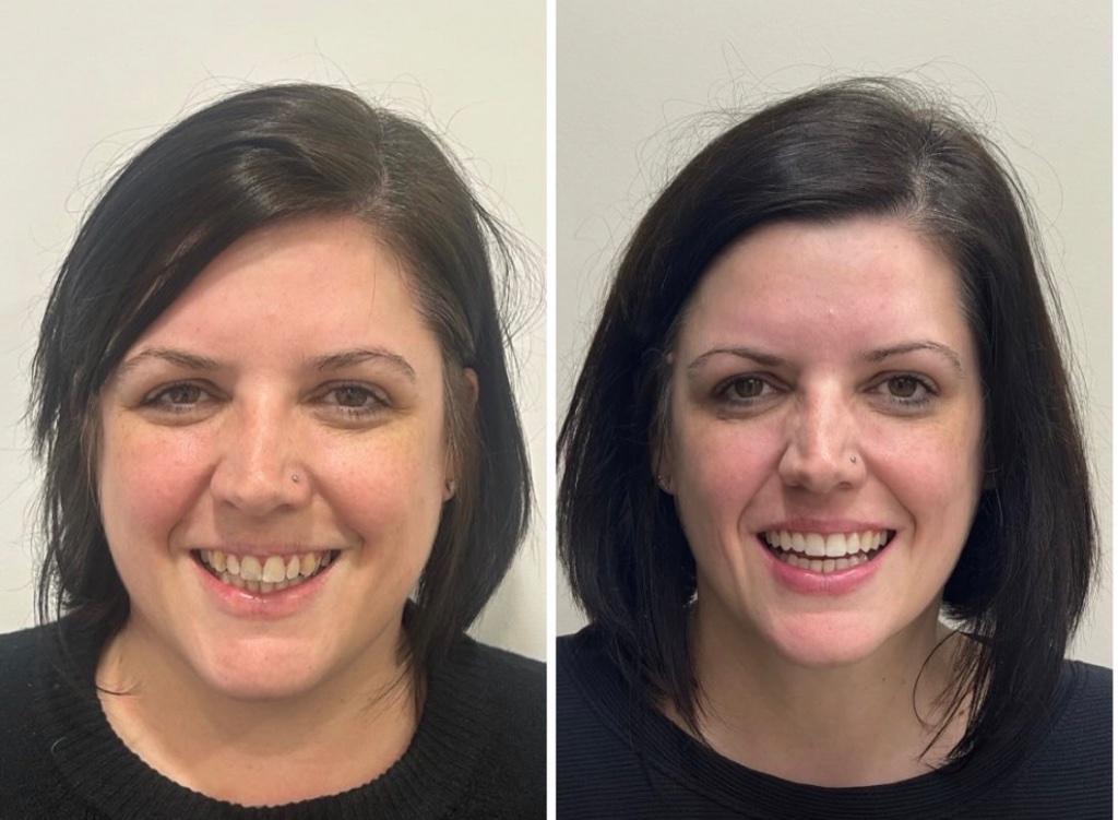 Invisalign smile transformation 6