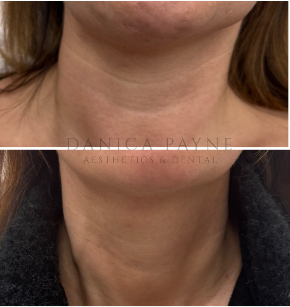 Neckline Rejuvenation — Before & After