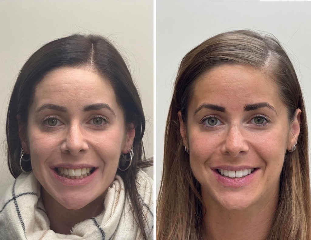 Dental Smile Makeover — Before & After