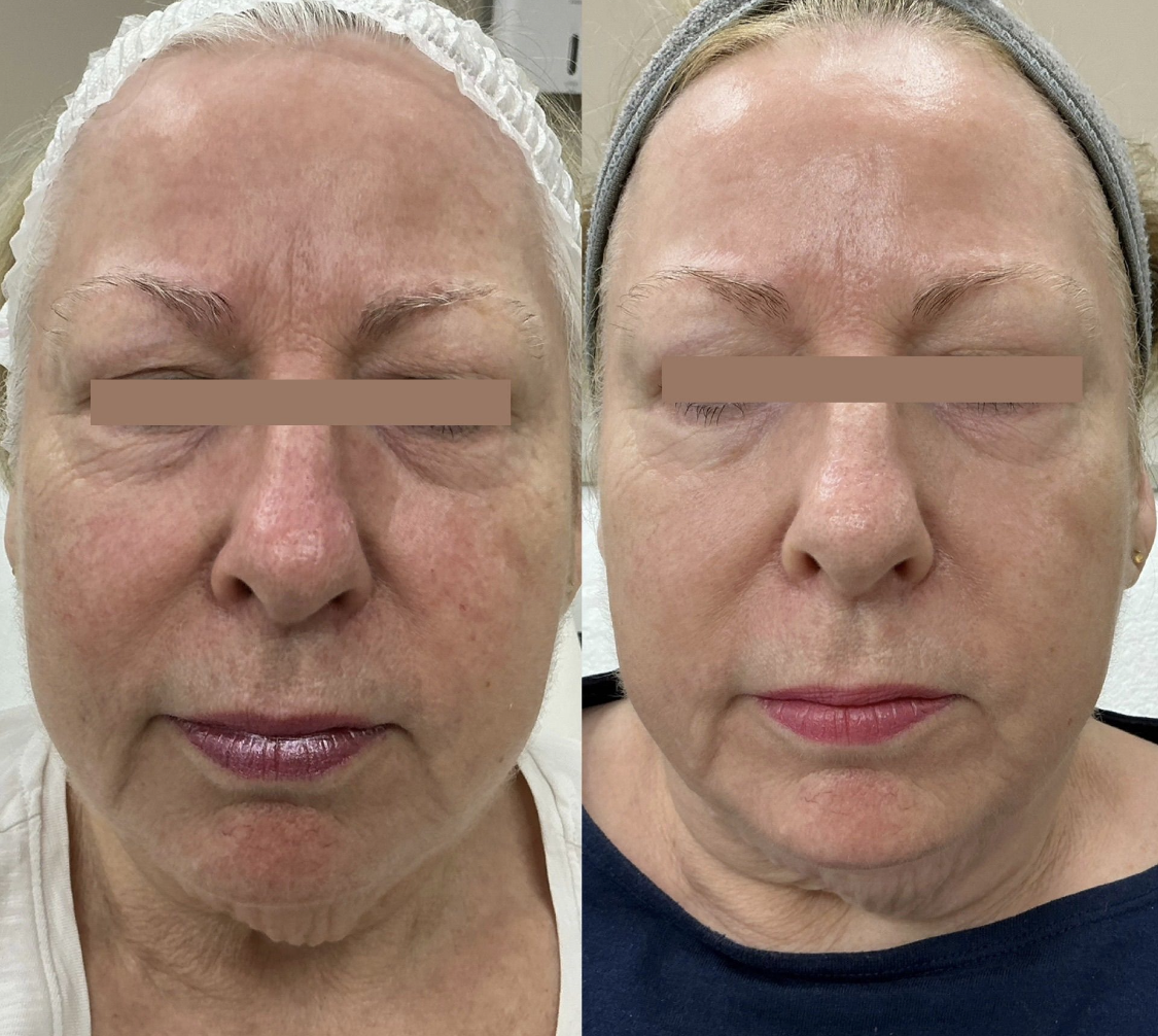 HIFU Facelift — Before & After