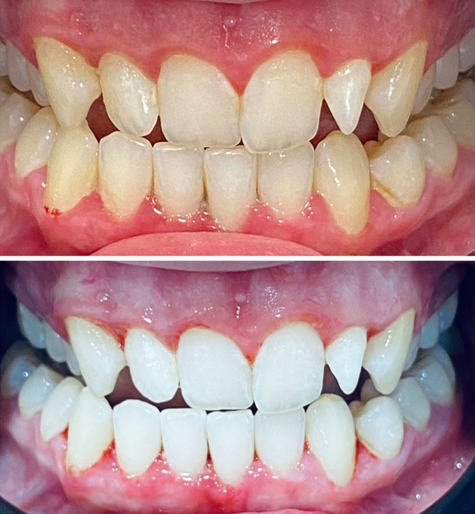 Teeth Whitening — Before & After