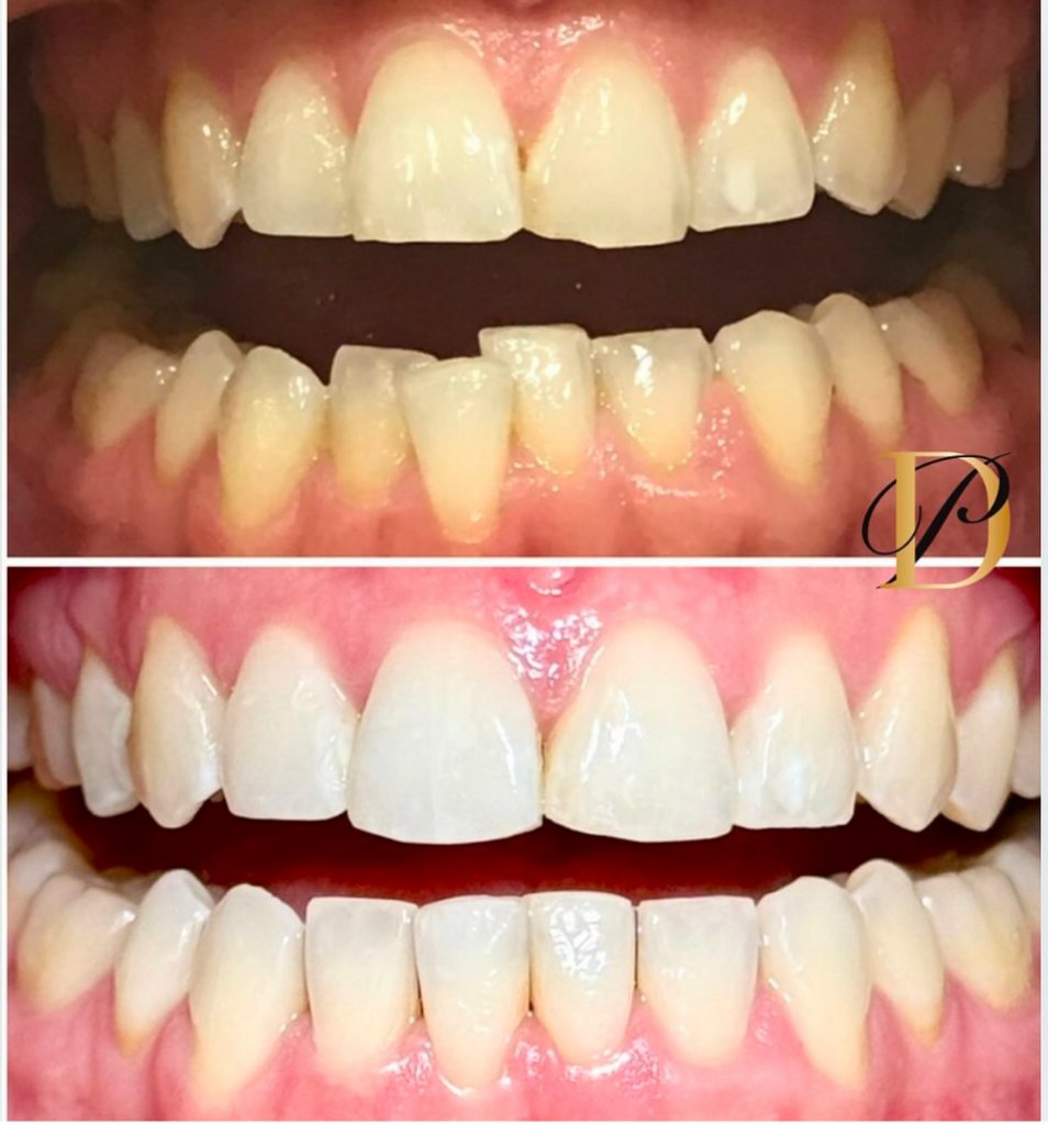 Dental Hygiene Treatment — Before & After