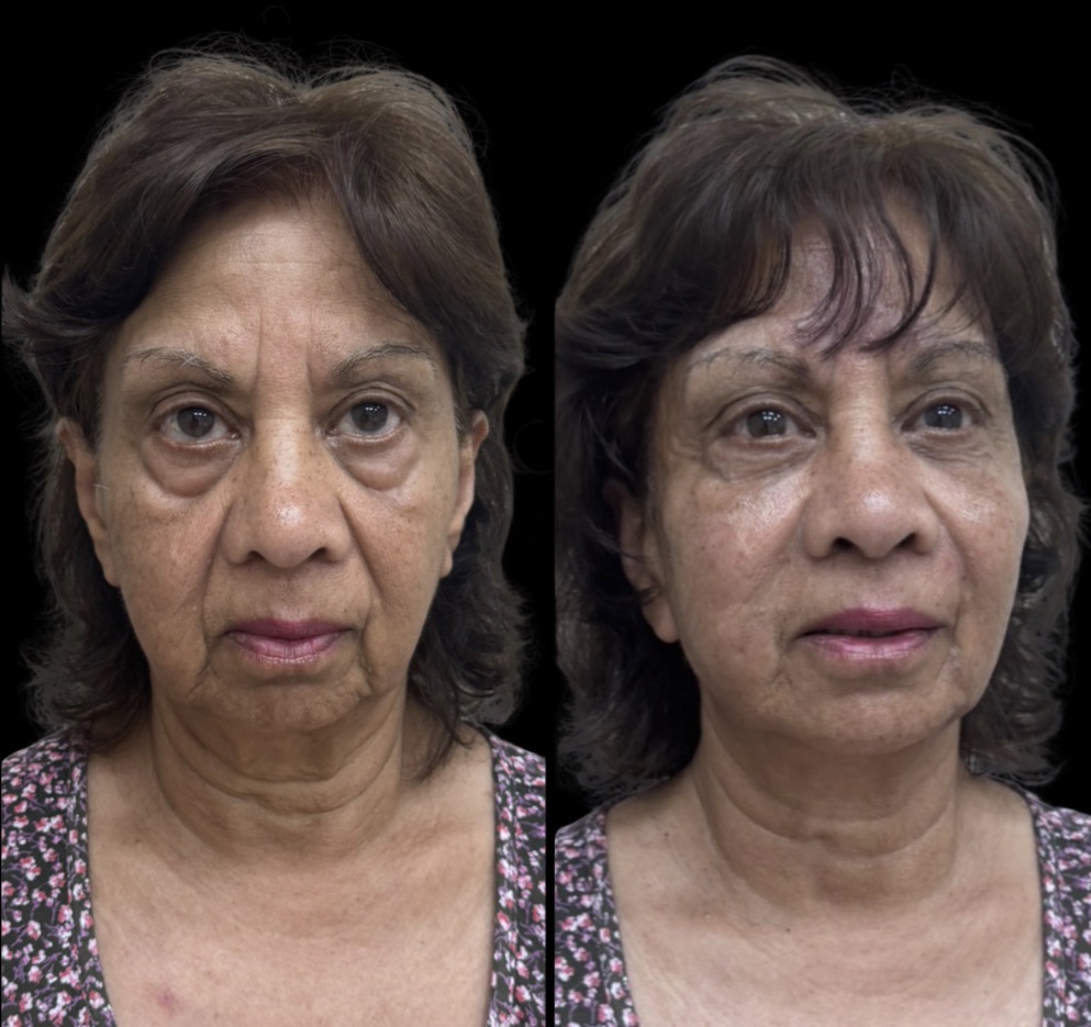 Full Face Rejuvenation — Before & After