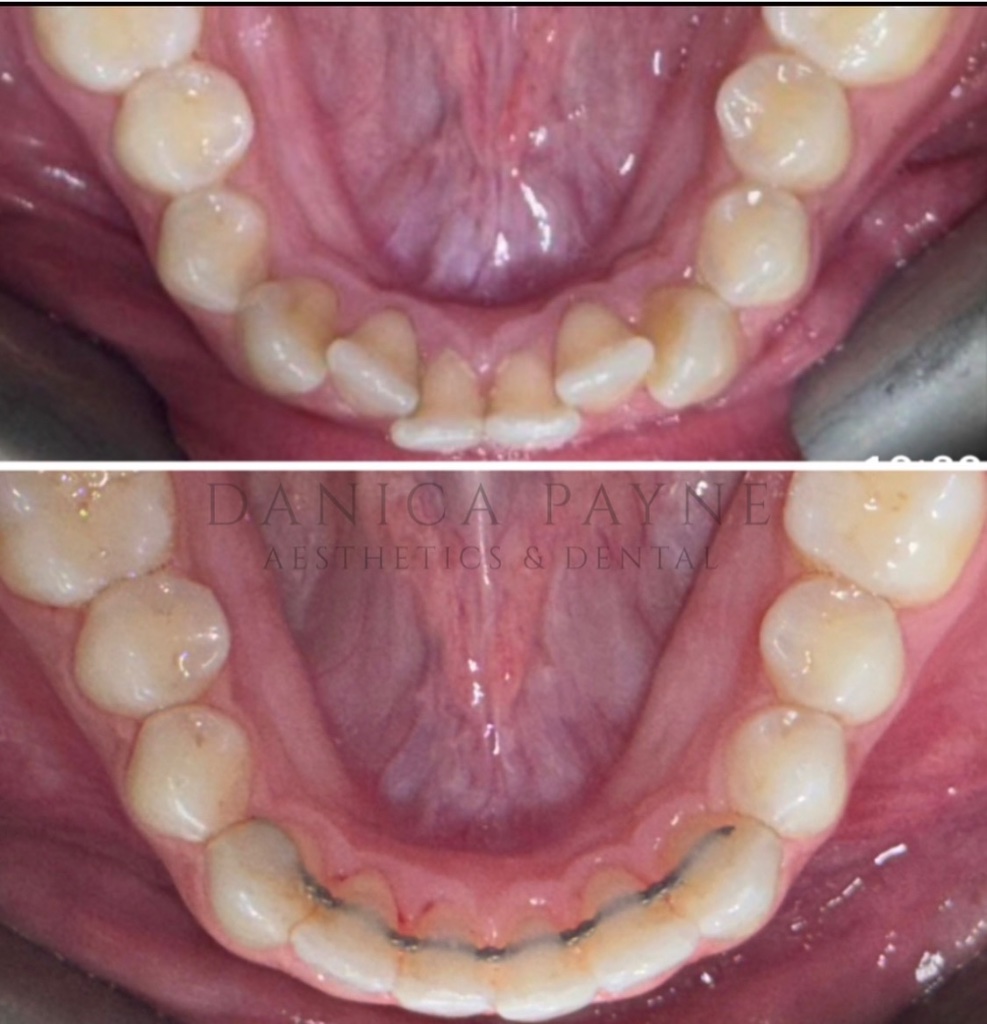Invisalign before and after transformation 5