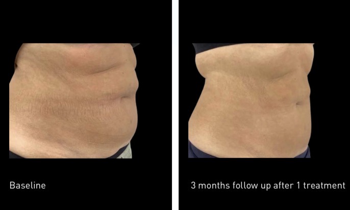 Abdomen fat freezing before and after — baseline vs 3 months follow up after 1 treatment