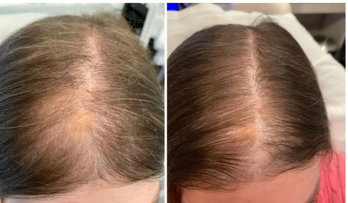 Hair Rejuvenation before and after 2