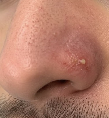 Nasal Pustule — Emergency