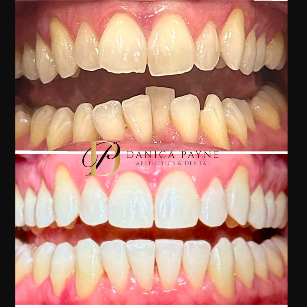 Teeth Straightening — Before & After