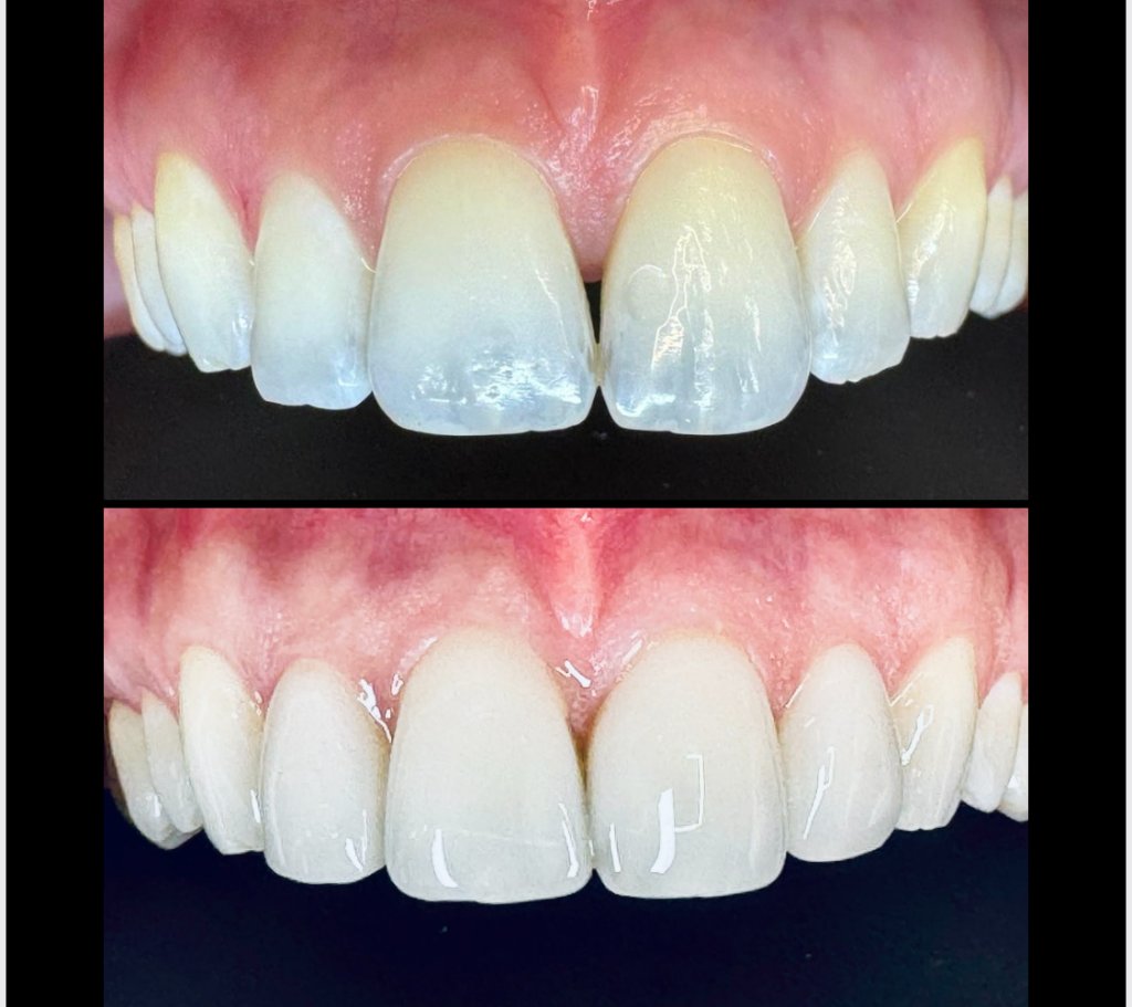 Composite Bonding — Before & After