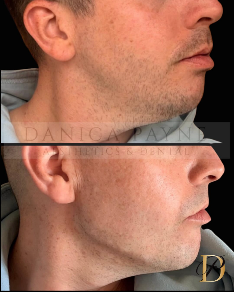Male Jawline Definition — Before & After