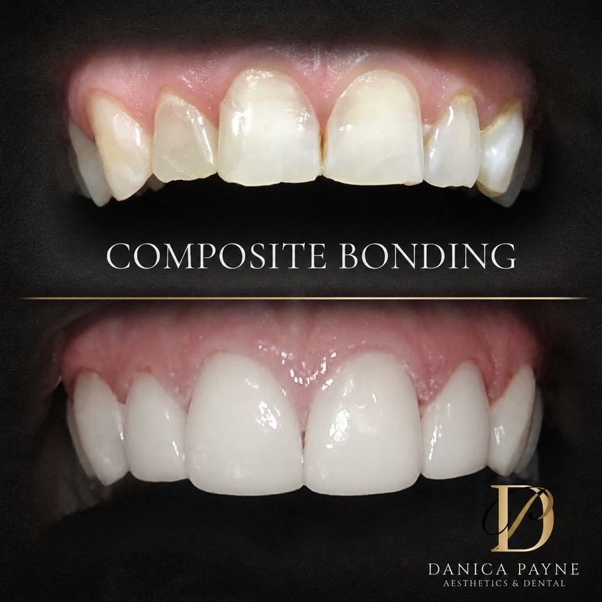 Composite bonding before and after — upper arch reshaped and whitened