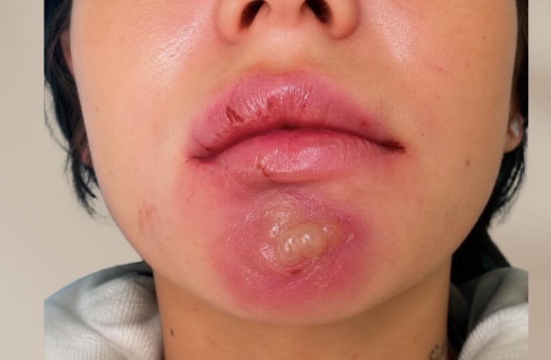 Chin Pustule — Emergency