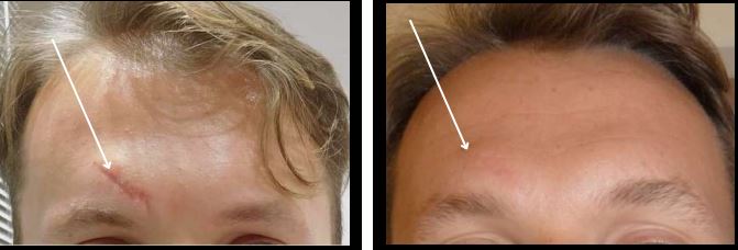 Laser Scar Treatment — Before & After