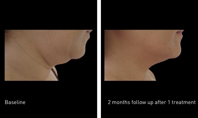 Chin and neck fat freezing before and after — baseline vs 2 months follow up after 1 treatment