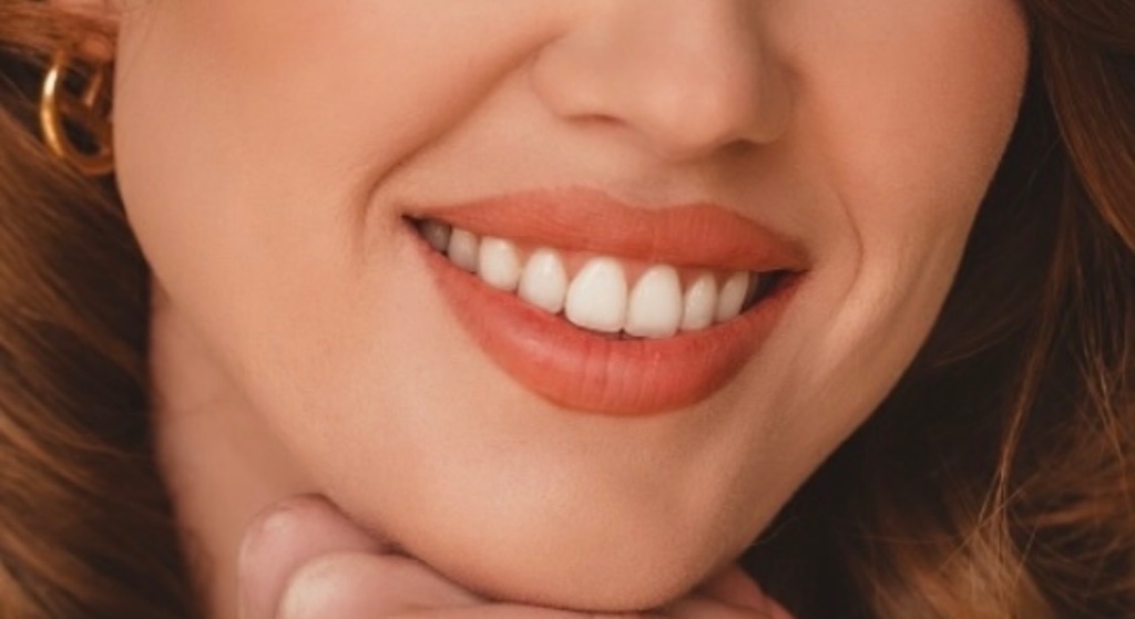 Patient smiling after composite bonding treatment