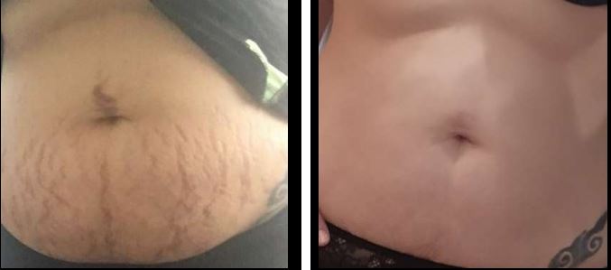 Laser Stretch Mark Reduction — Before & After