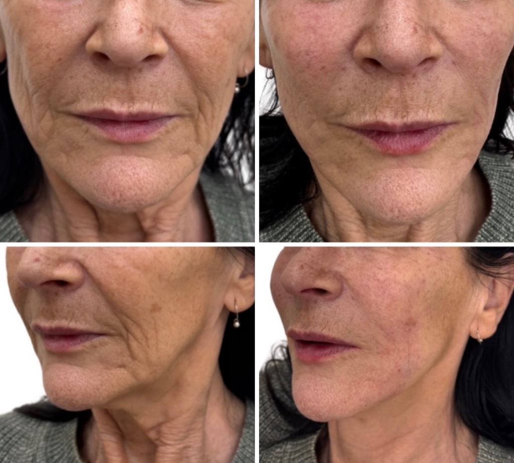 Injectables gallery 3