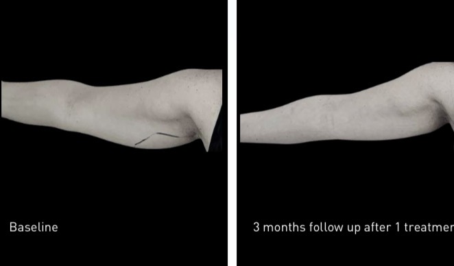 Upper arm fat freezing before and after — baseline vs 3 months follow up after 1 treatment