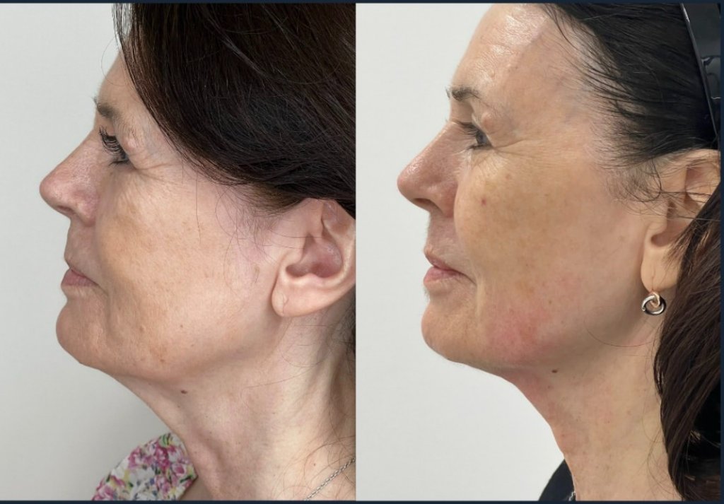 HIFU Treatment — Before & After