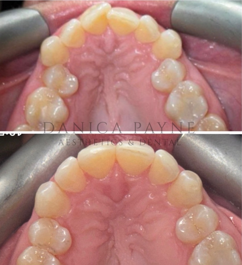Invisalign before and after transformation 6