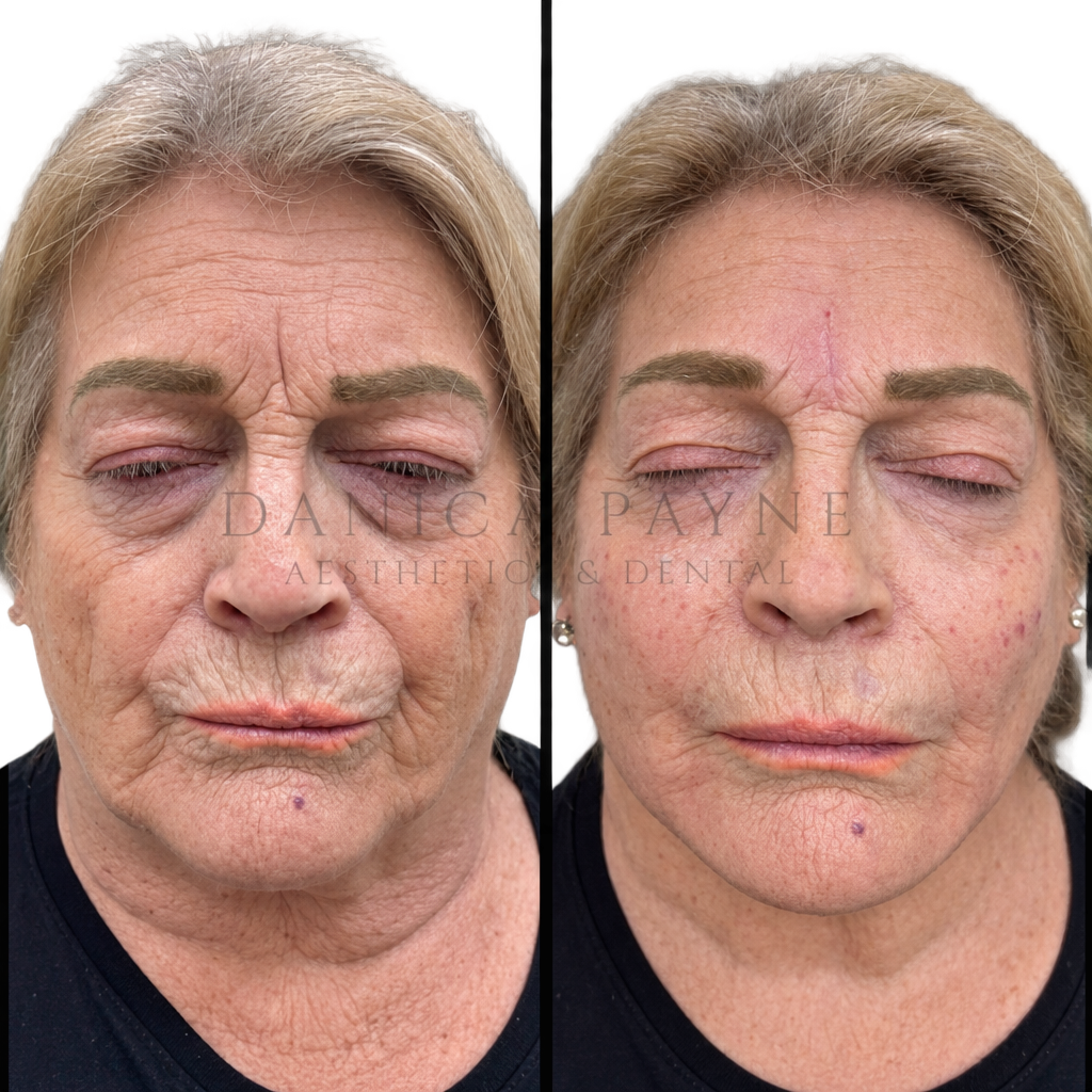 Full Face Rejuvenation — Before & After