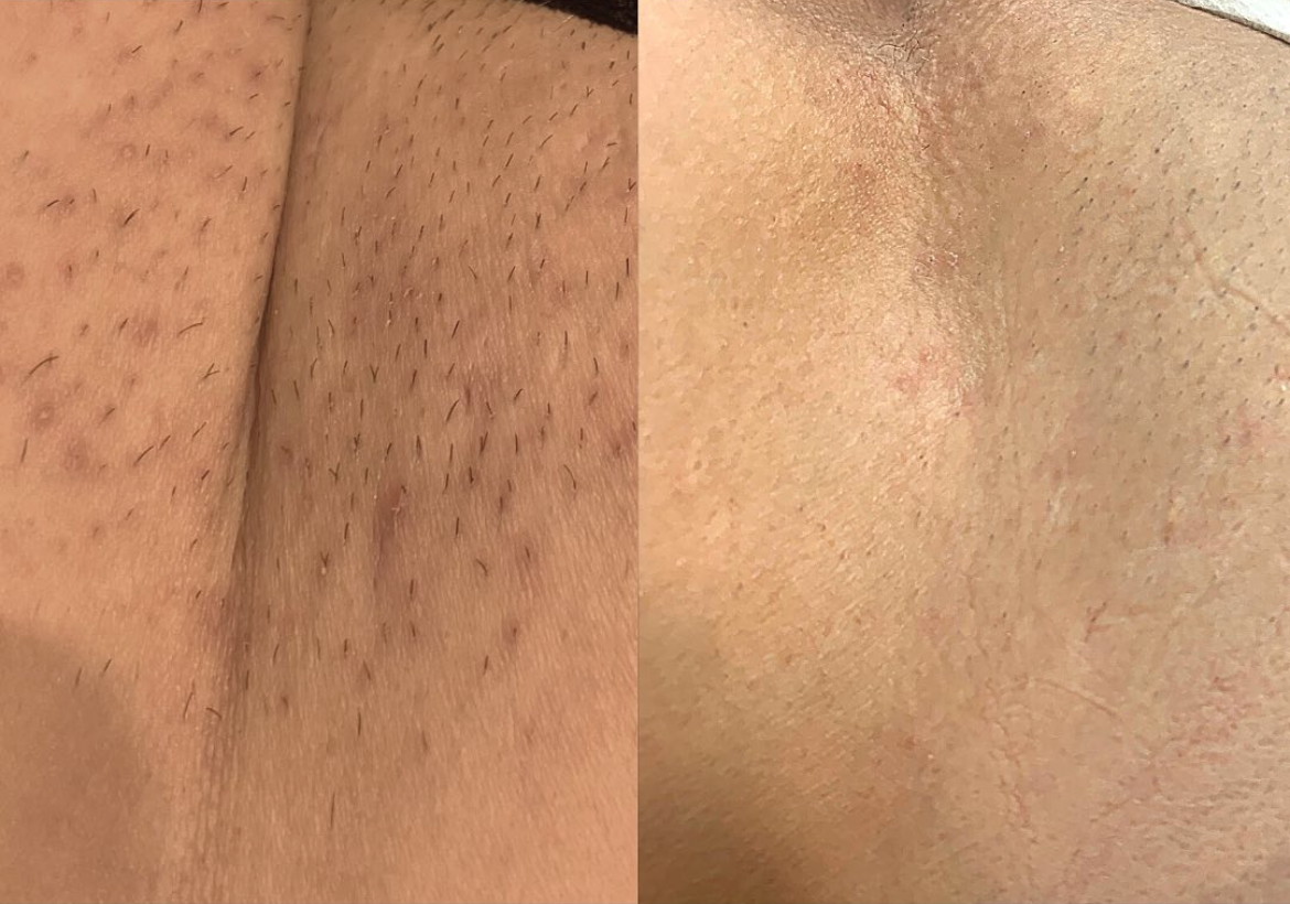 Laser Hair Removal — Before & After
