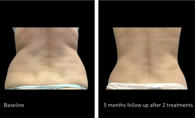Back skin tightening before and after — baseline vs 5 months follow up after 2 treatments